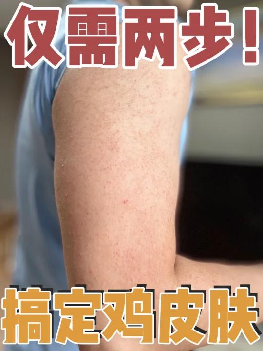 仅需2步手把手教你搞定鸡皮肤