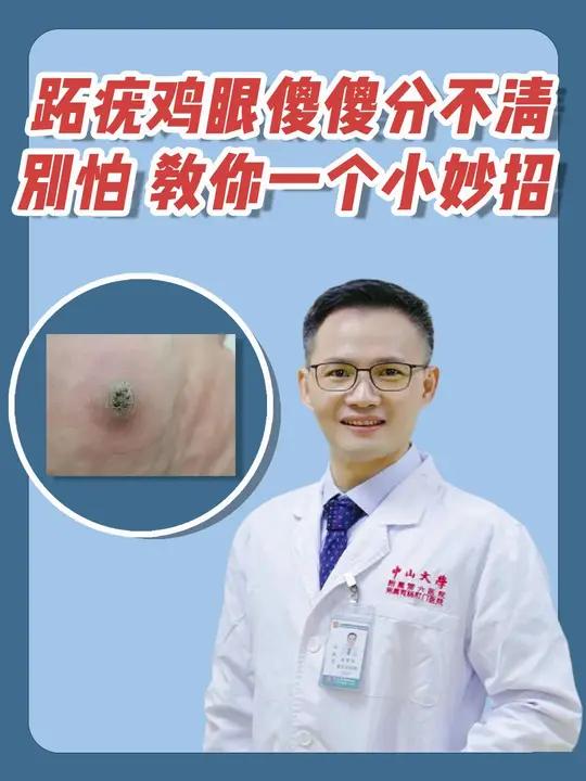 跖疣鸡眼傻傻分不清？别怕，皮肤科主任教你一个小妙招