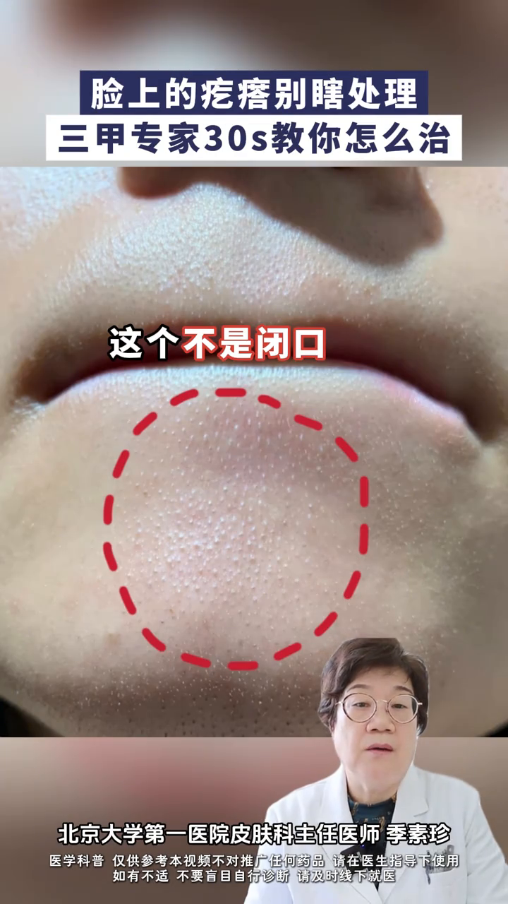 脸上这三种疙瘩千万别乱抠,三甲专家30s教你怎么做