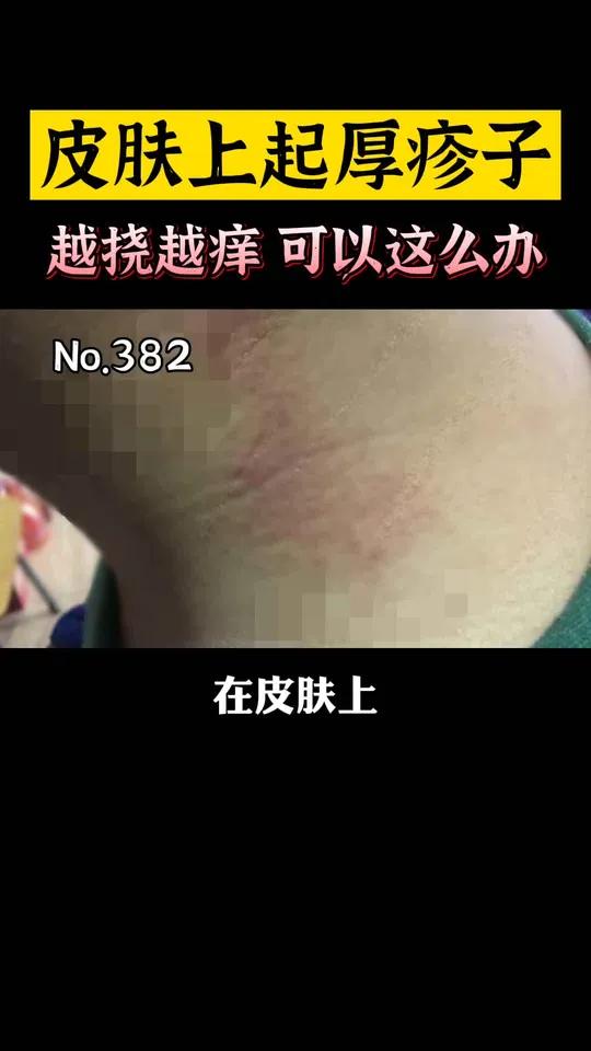 皮肤上起厚厚的红疹子,千万别挠!越挠越痒,可以这么处理