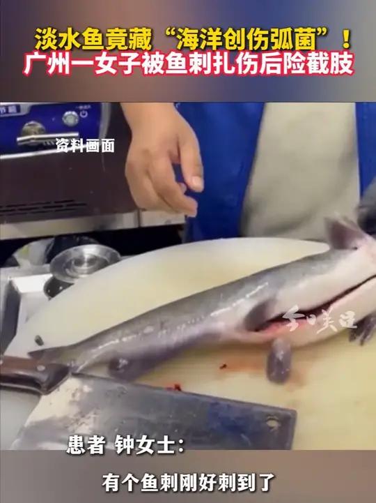 所幸,钟女士治疗及时,避免了截肢风险,目前已康复出院。据了解,海洋创伤弧菌是一种栖息于海洋