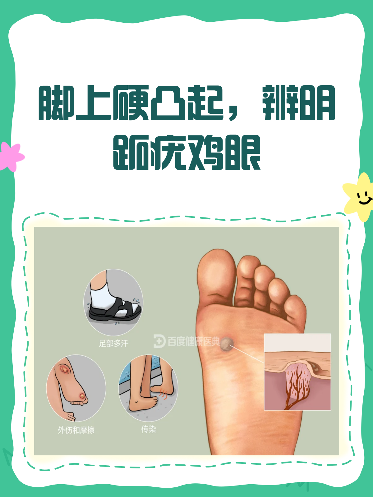 脚上硬凸起？别急，先辨明是跖疣还是鸡眼！