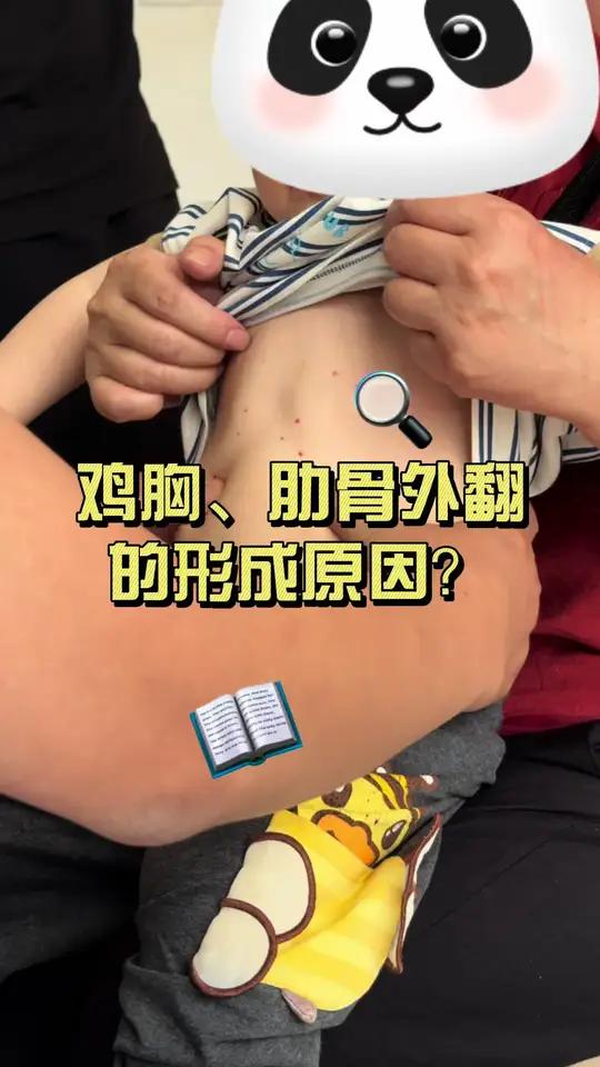 鸡胸、肋骨外翻的形成原因