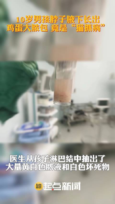 「警惕猫抓病!10岁男孩腋下鸡蛋大脓包竟是猫抓病」近日浙江杭州,杭州市红十字会医院接诊了一