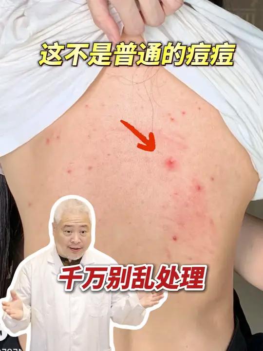 前胸后背长红疙瘩,千万别当普通痘痘!医生教你一招,科学处理!