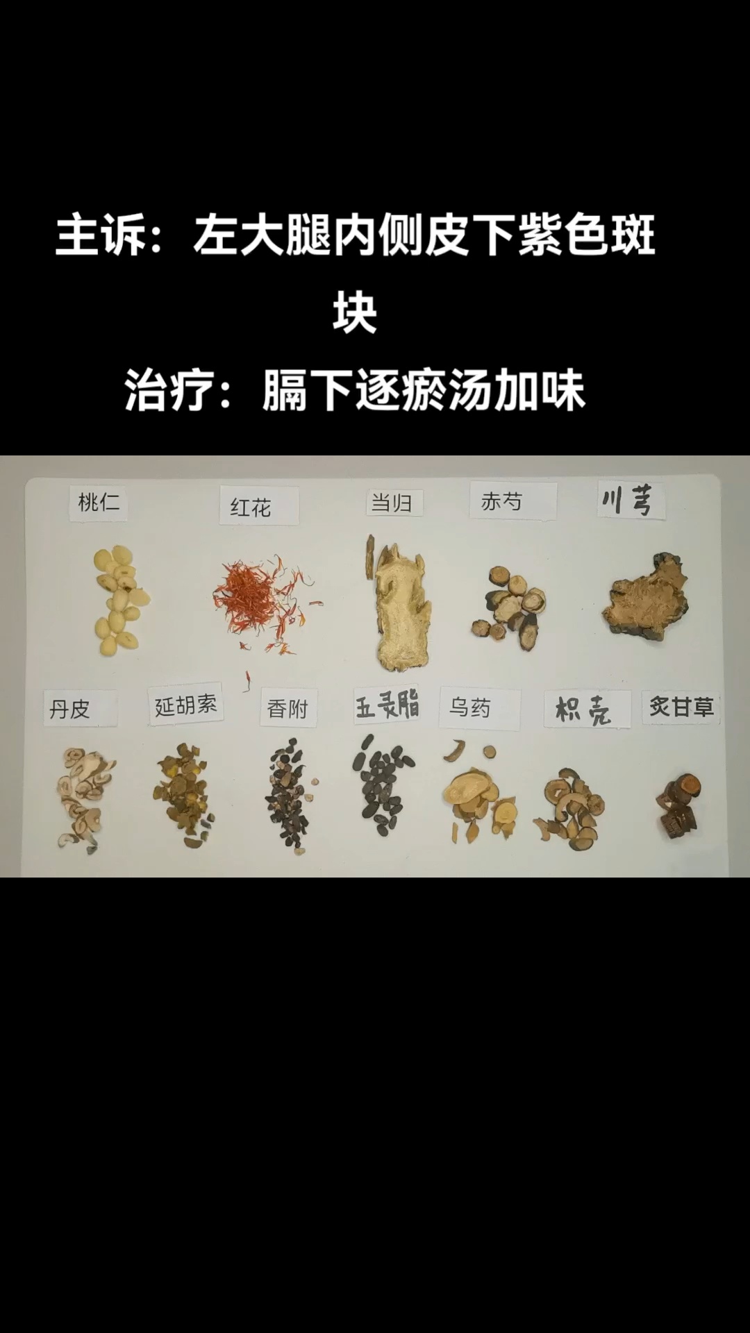 左大腿内侧皮下紫色斑块(2022.5.5)
