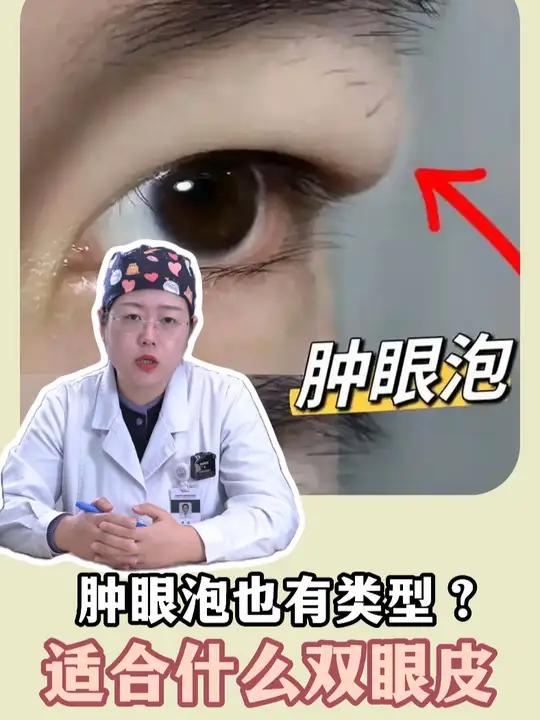 肿眼泡也有类型?适合做哪类双眼皮?