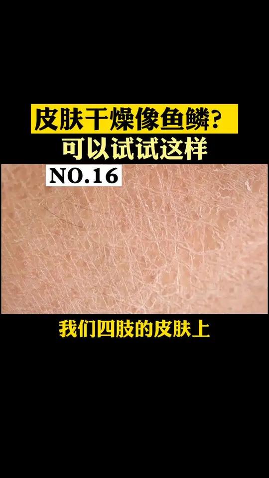 皮肤干燥得像鱼鳞,特别难看,衣服上都是白色皮屑!这就是