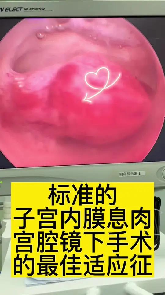 女性子宫里面长啥样?什么是子宫内膜息肉?宫腔镜下手术