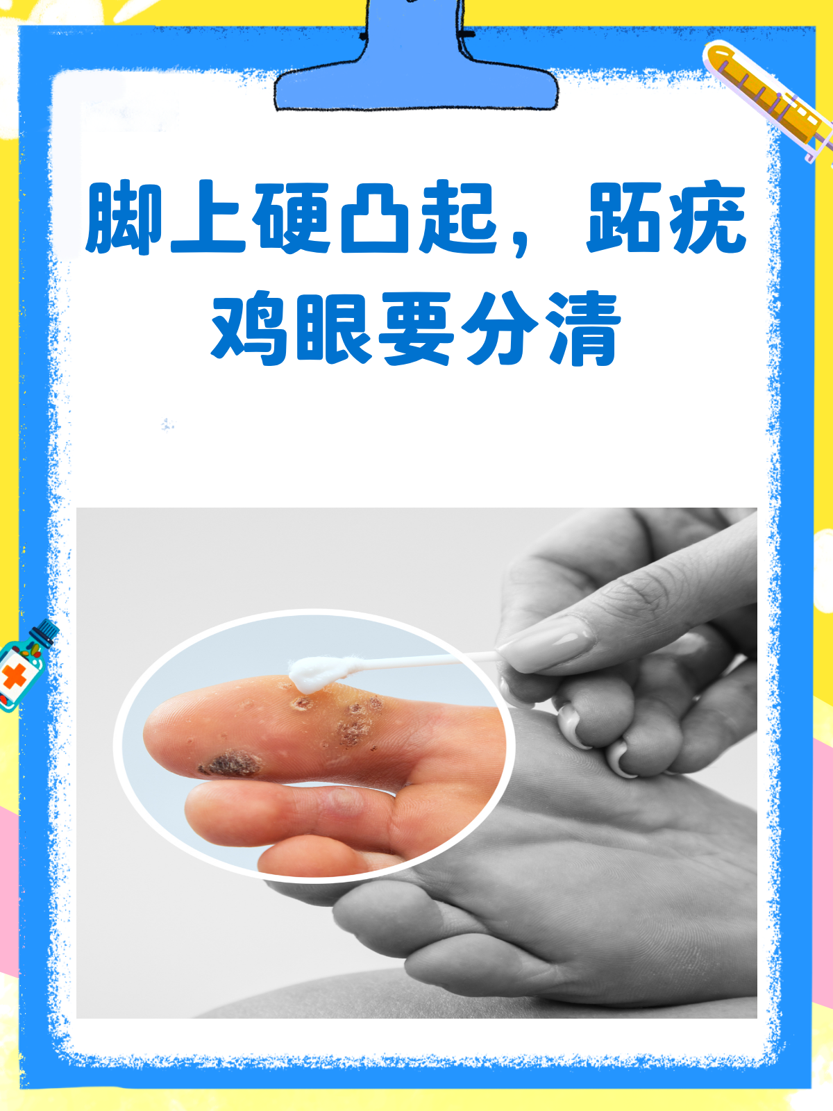 脚上硬凸起?揭秘跖疣、鸡眼的真相!