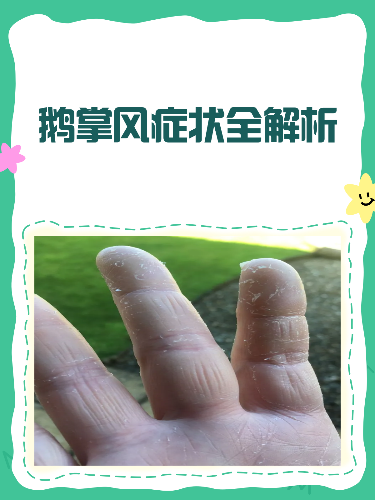 鹅掌风大揭秘!症状图片全解析