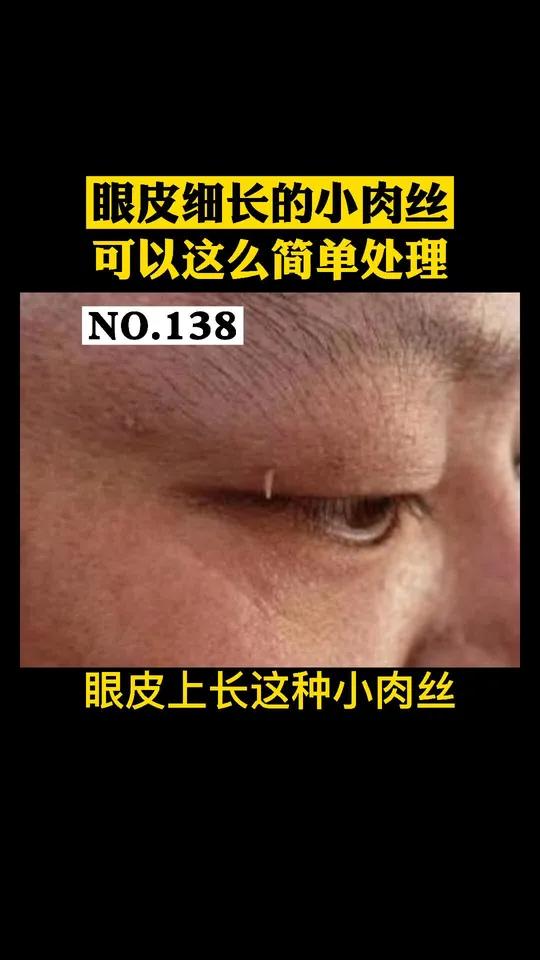 眼皮上长细长的小肉丝,俗称刺瘊子,可以怎么处理呢