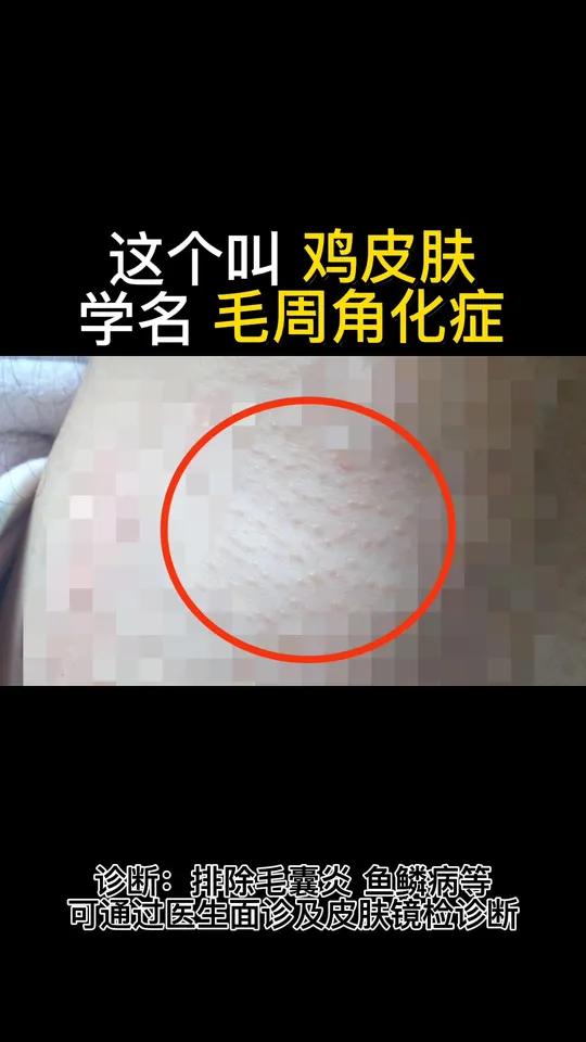 鸡皮肤十分难看,皮肤科教授来帮您,5秒教会你处理