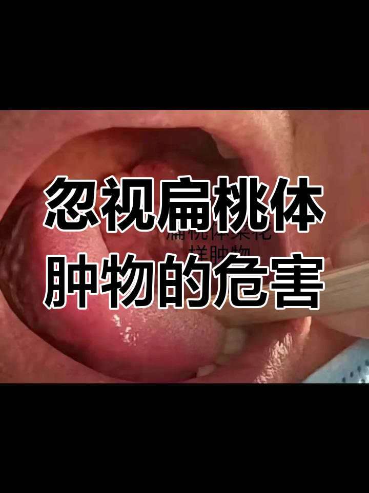 扁桃体肿物未及时治疗,后果严重