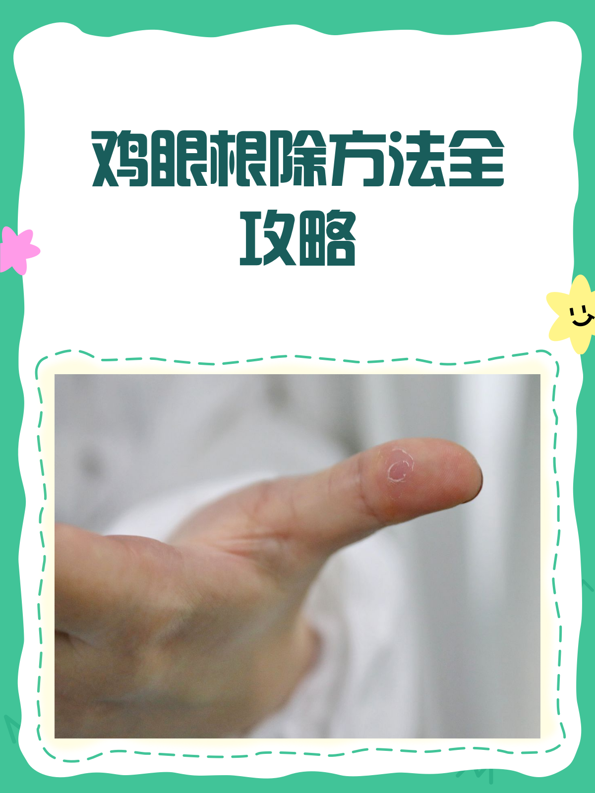 鸡眼怎么治？药物、物理、手术方法全解析！