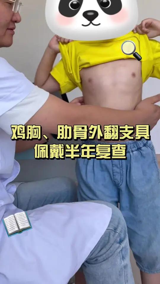 鸡胸、肋骨外翻支具治疗半年复查