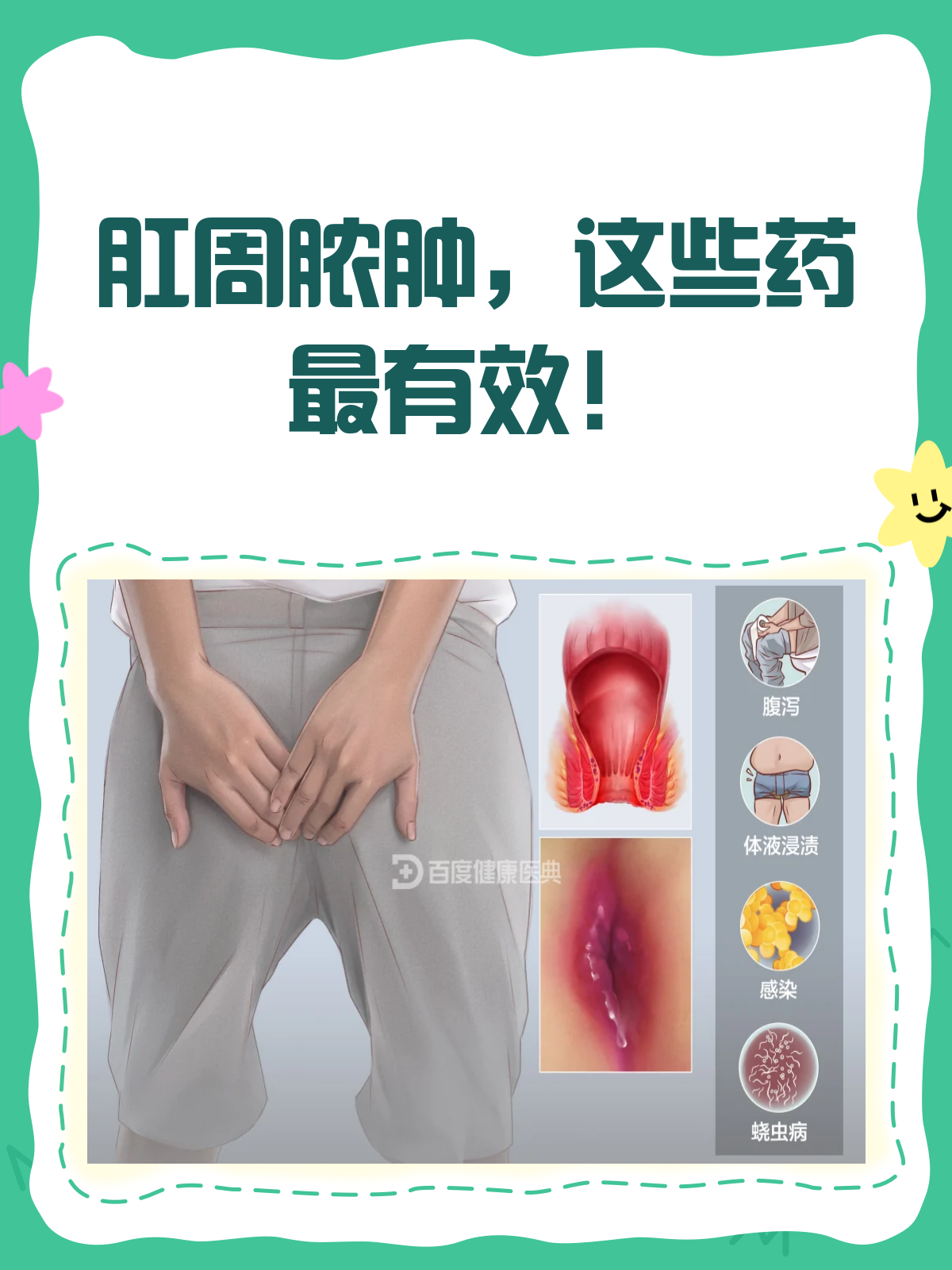 肛周脓肿怎么办?这些药物来帮忙