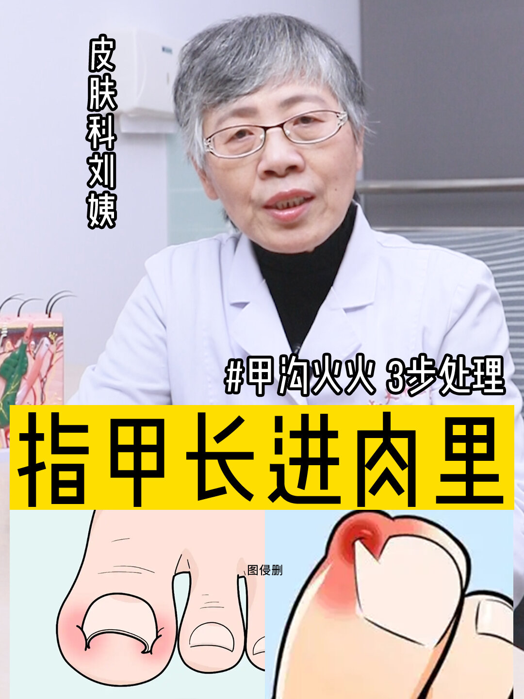 指甲长进肉里,又红又疼,3步护理!