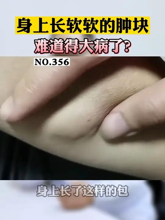 身上小肉球,软软的,可能是脂肪瘤,不要摁
