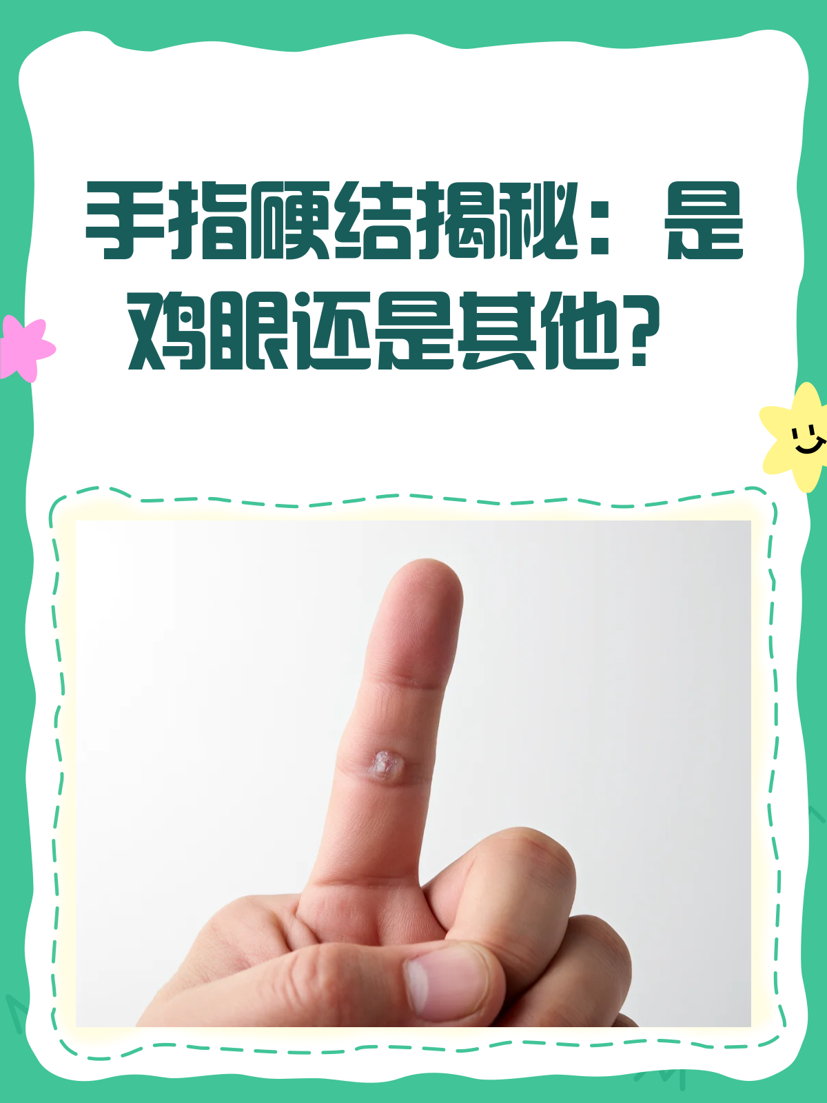 手指上长“鸡眼”?别急,先看看这篇!