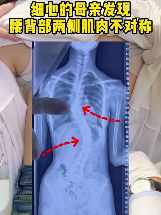 细心的母亲发现腰背部两侧肌肉不对!