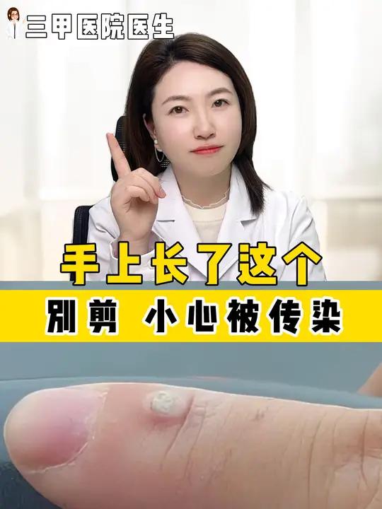 手上长这种硬硬的肉疙瘩,别去剪,会传染!