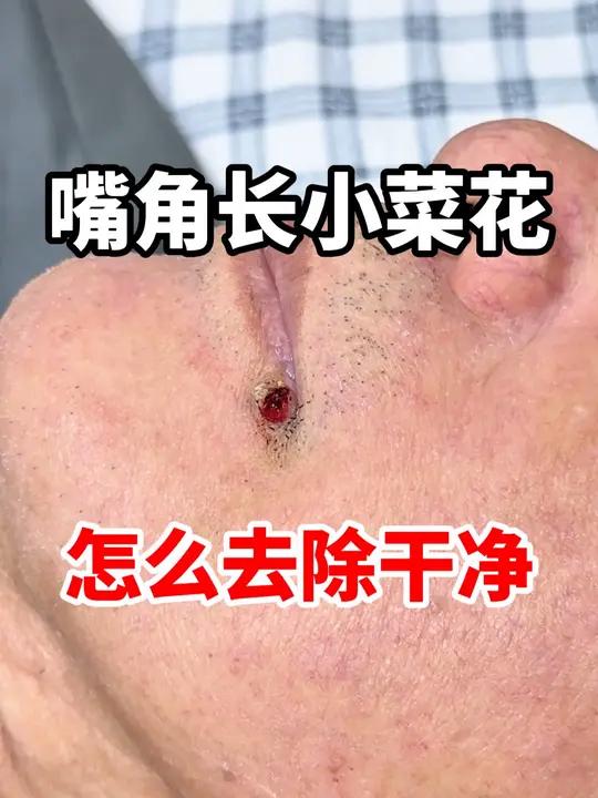 嘴角长小菜花 怎么去除干净 #hpv #寻常疣 #瘊子 #抖出健康知识宝藏 #新年囤点专业