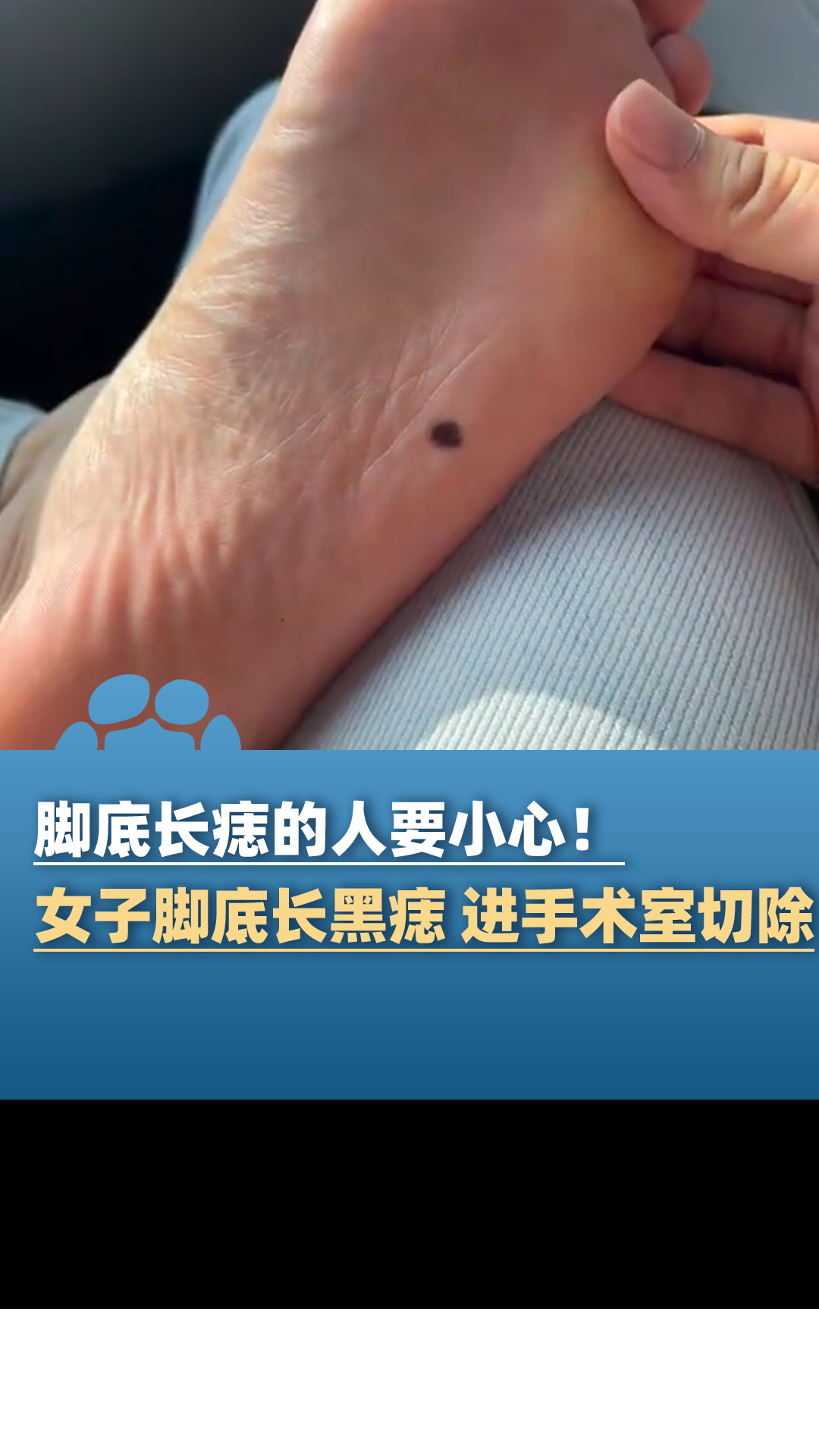 脚底长痣的人要小心!女子脚底长黑痣 被送进手术室切除