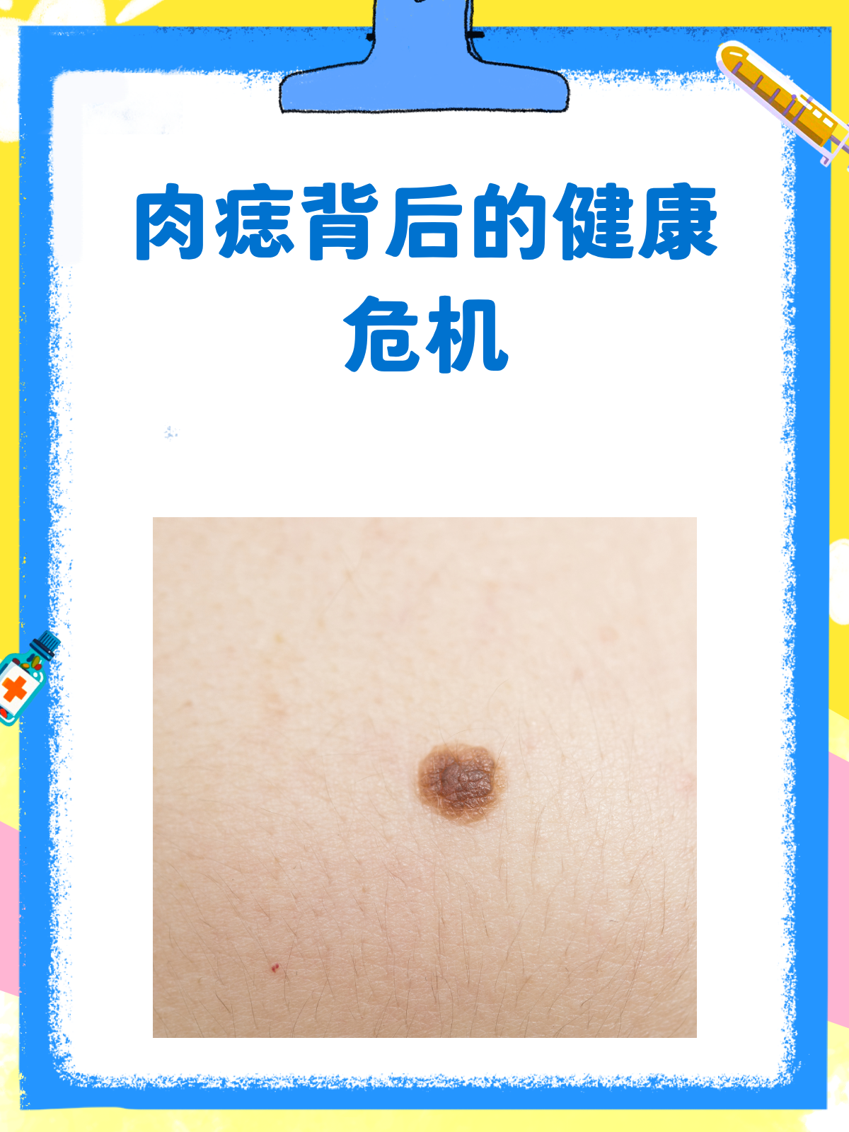 一颗肉痣竟藏健康危机?快来了解真相