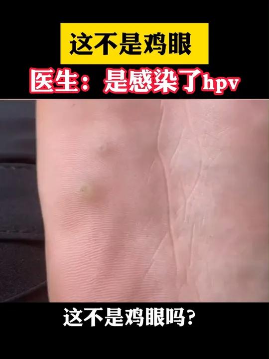 脚底这种疙瘩不是鸡眼,而是hpv感染引起的跖疣。任何年龄都可能