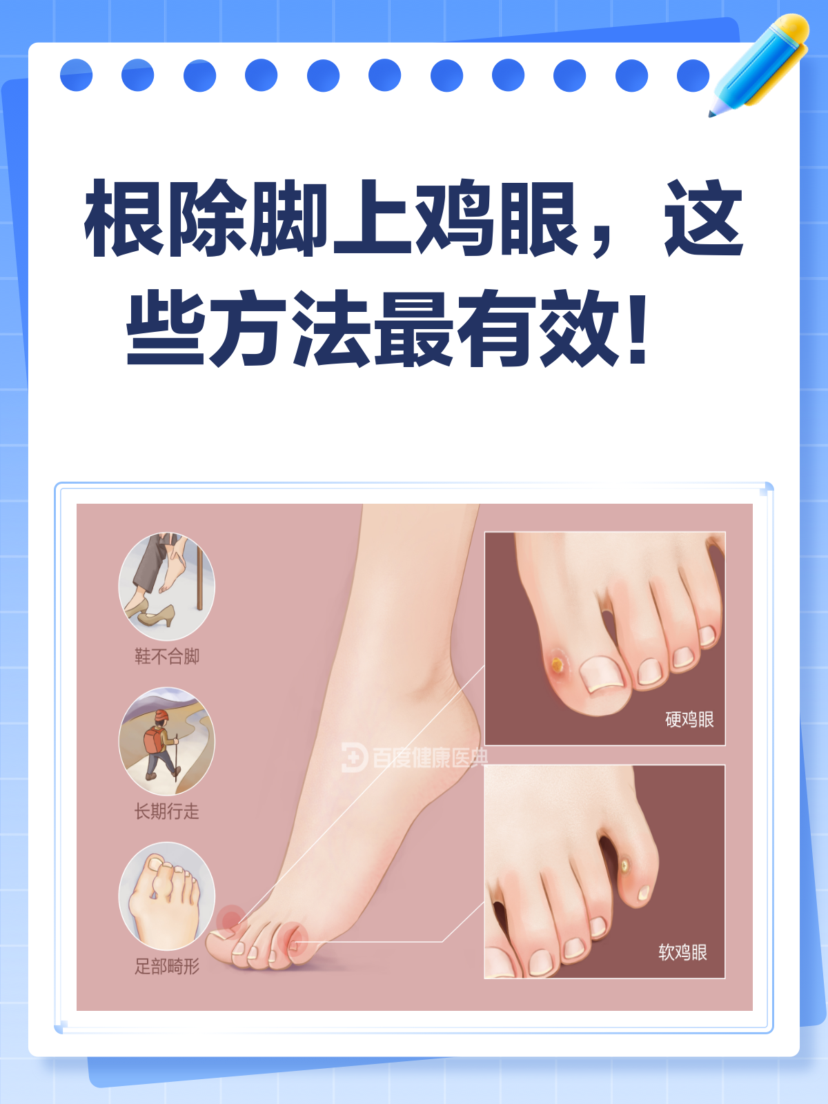 脚上鸡眼惹人烦?这样治疗才能根除!