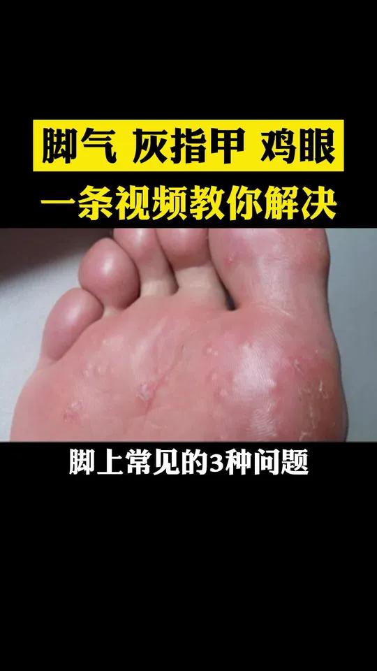 脚气、灰指甲、鸡眼,脚上的问题,一个视频教你解决