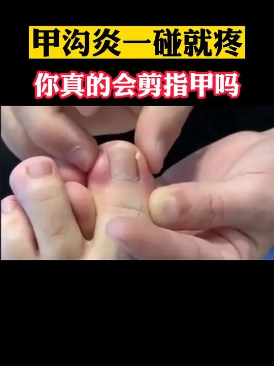 指甲长进肉里,一碰就痛,教你简单处理