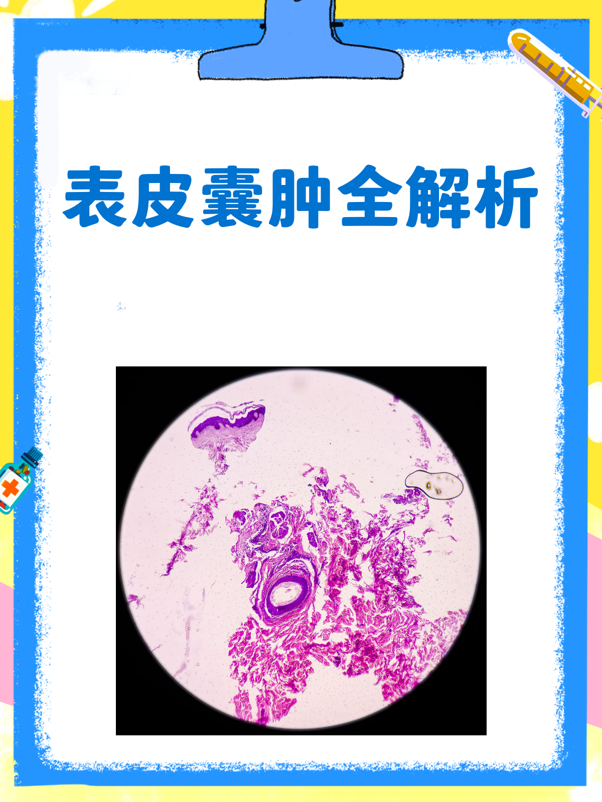 表皮囊肿知多少?原因、症状与治疗全解析!