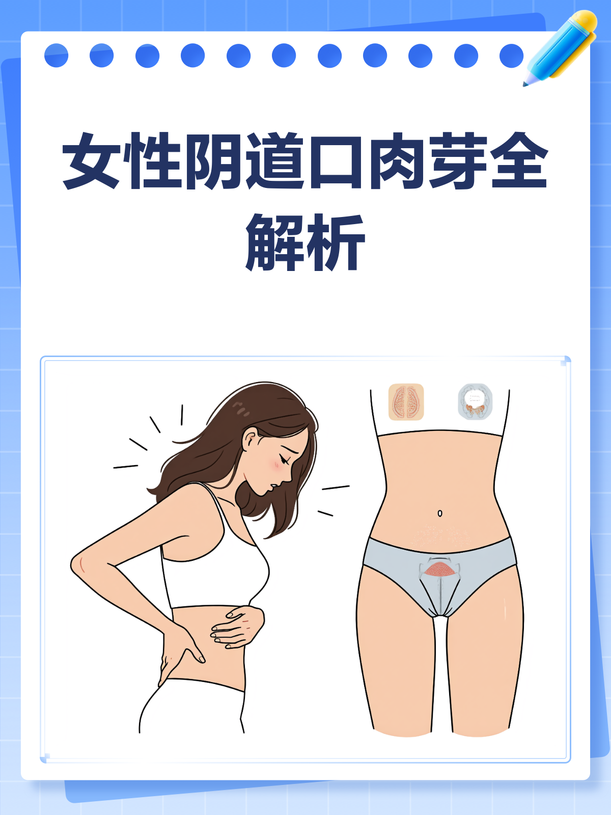发现阴道口肉芽?别慌,先了解这些