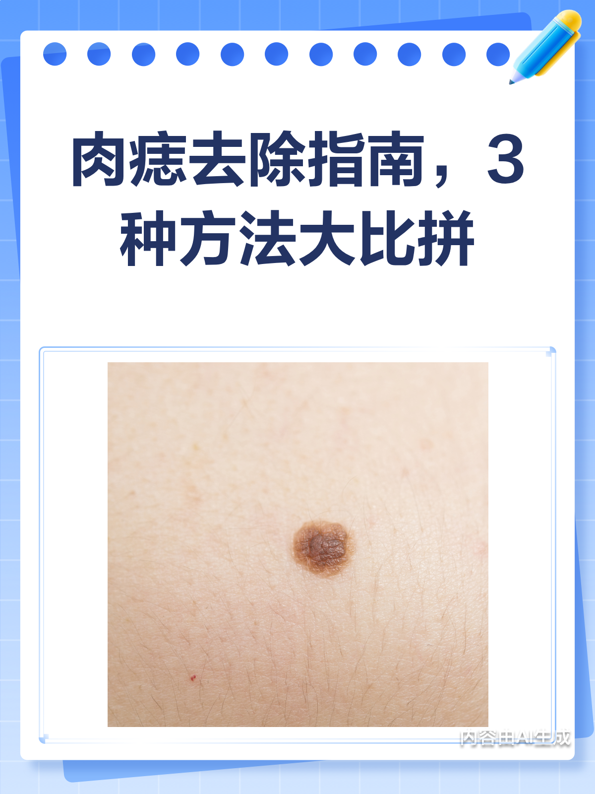 肉痣去除必看!3种方法大比拼