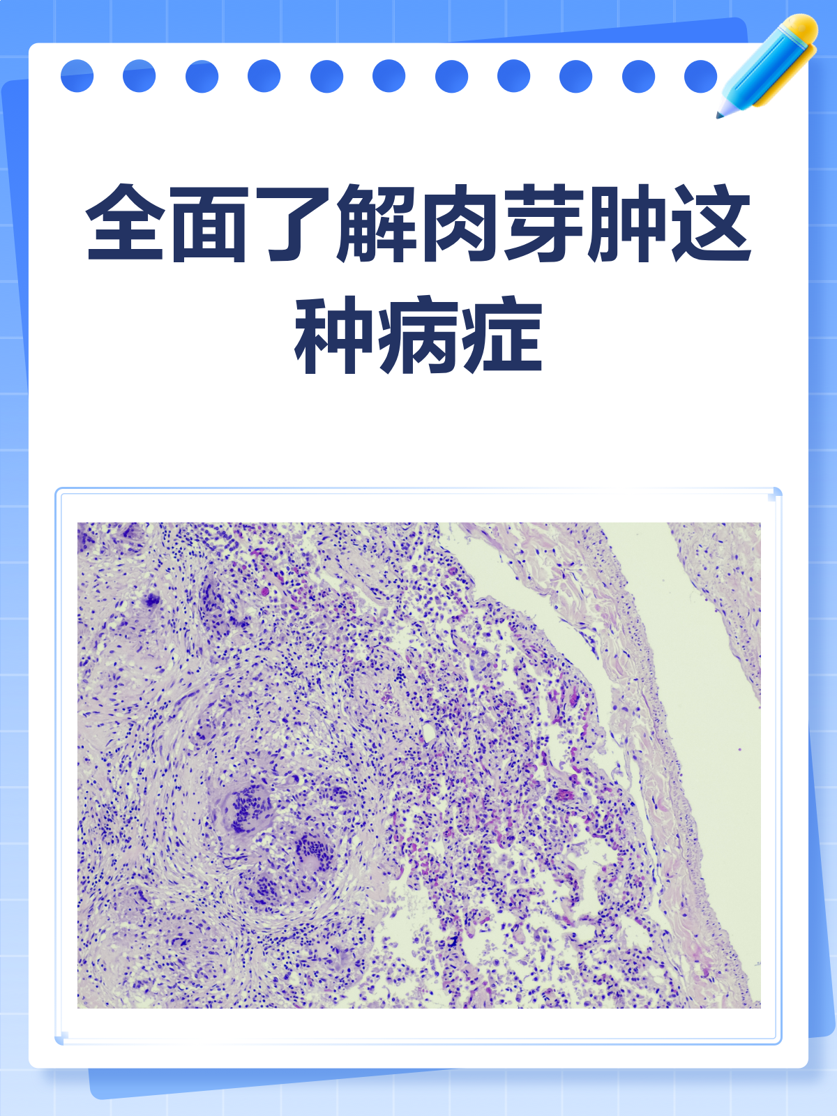 肉芽肿揭秘：身体里的“小疙瘩”到底是什么？