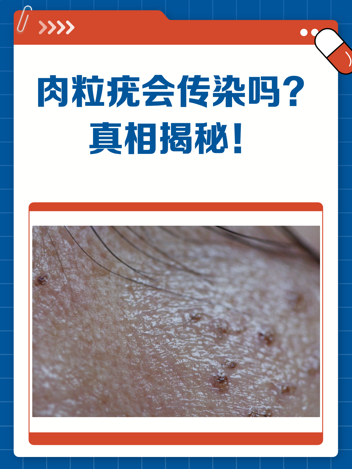 肉粒疣会传染吗?答案在这里!