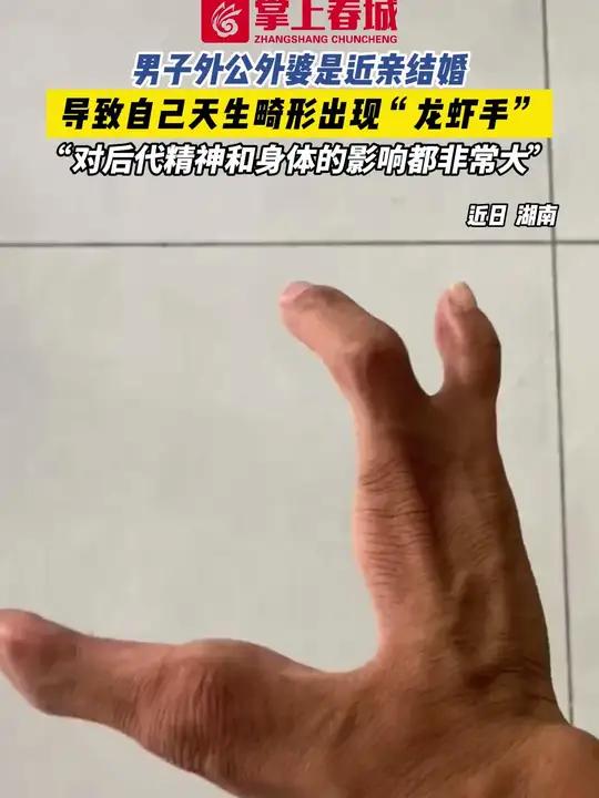 男子外公外婆是近亲结婚,导致自己天生畸形出现“龙虾手” “对后代精神和身体的影响都非常大”