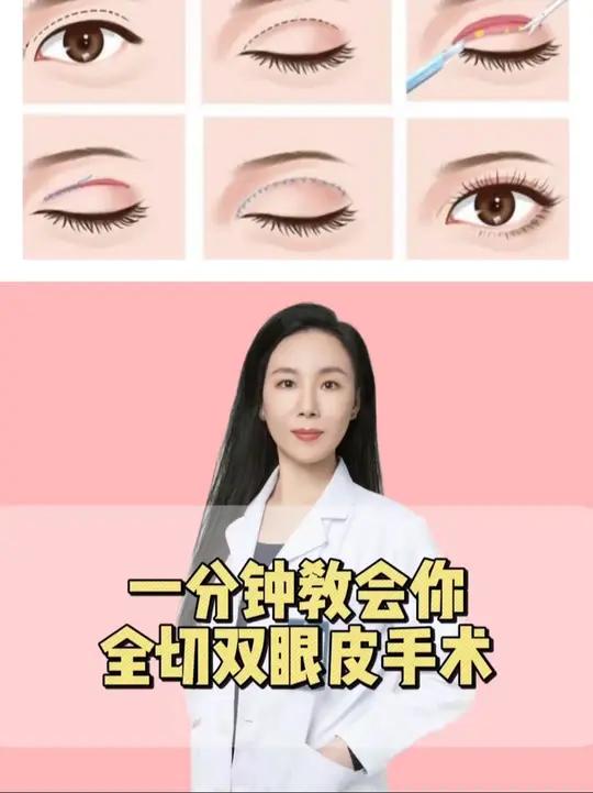 带你沉浸式体验一分钟做完双眼皮全切手术!双眼皮 全切双眼皮