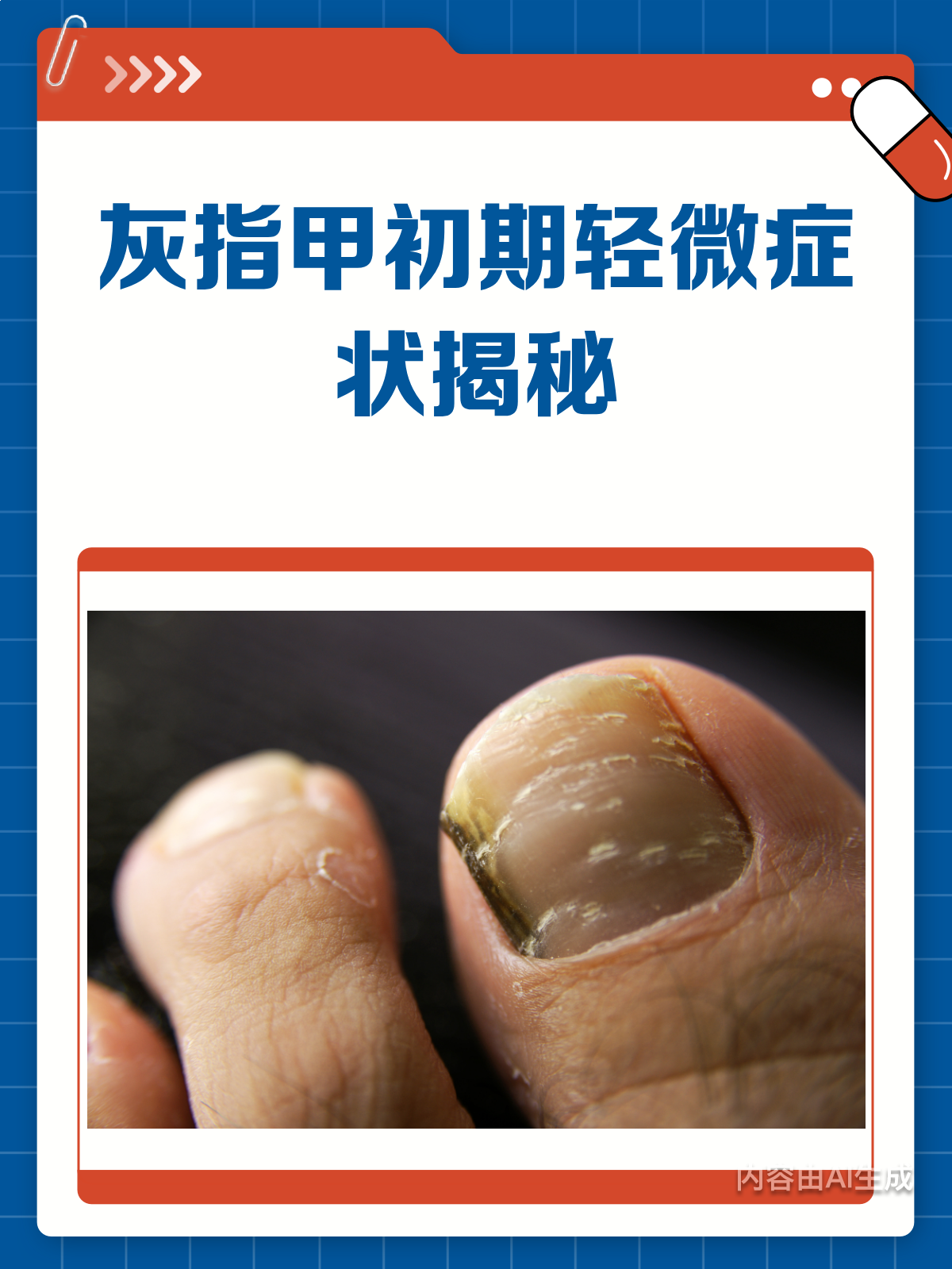 灰指甲初期长啥样?快来对照自查
