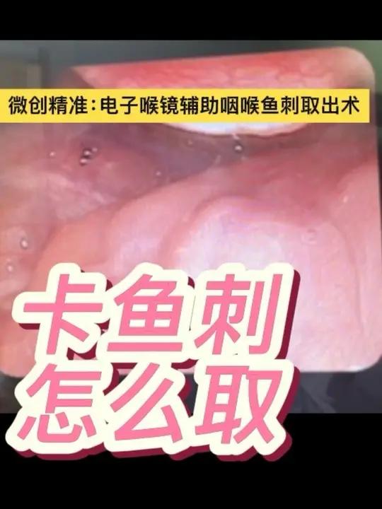 微创精准：电子喉镜辅助咽喉鱼刺取出术，电子喉镜下咽喉异物（鱼刺）取出术实录
