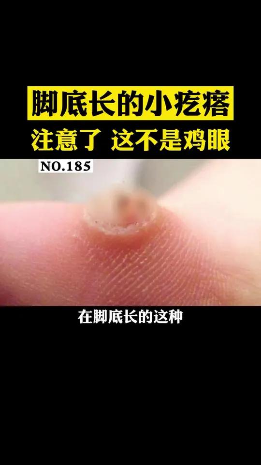 脚底长灰黄色的小疙瘩,走起路来很疼,这是跖疣,别乱抠,可以这样处理!