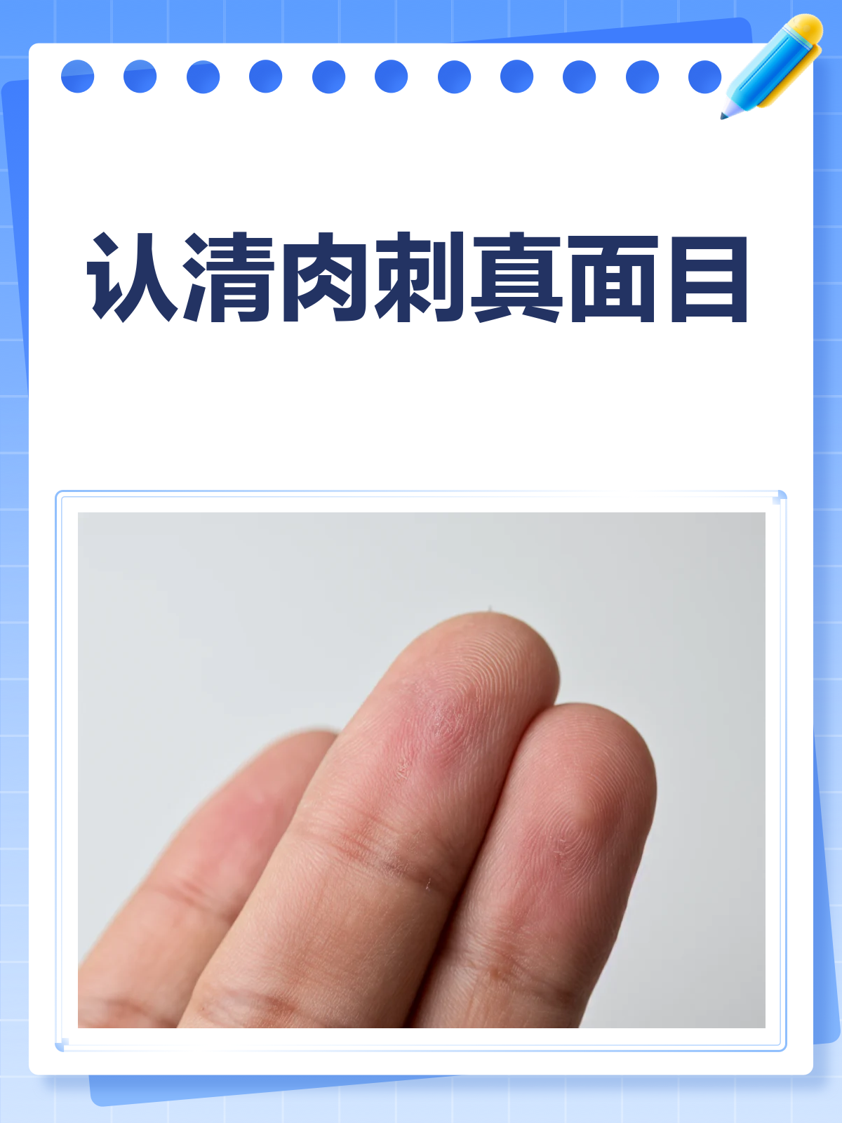 肉刺长啥样?一文带你认清肉刺!