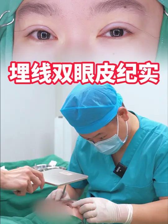 埋线双眼皮我一般会在最后缝线的时候勒的比较紧,这样可以降低后期埋线脱落的概率,但是术后即刻