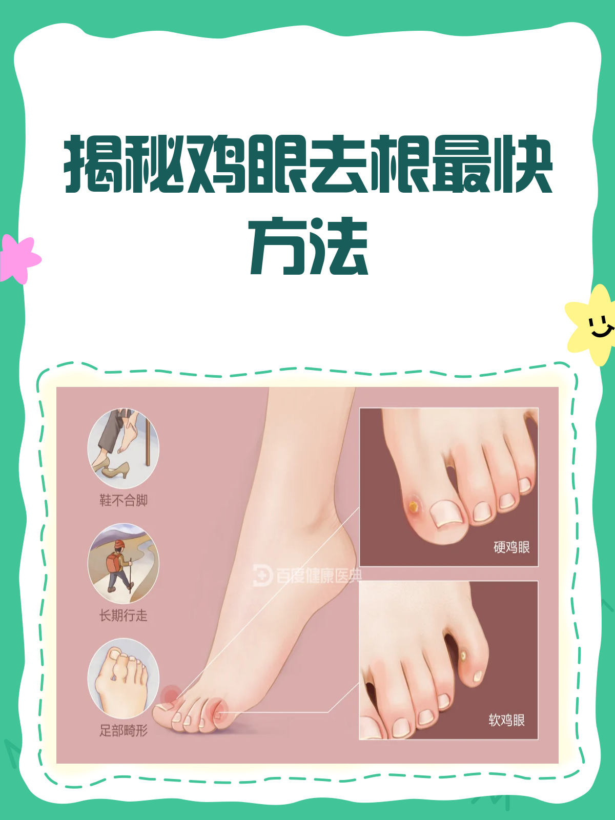 鸡眼去根秘籍,快速摆脱疼痛烦恼!