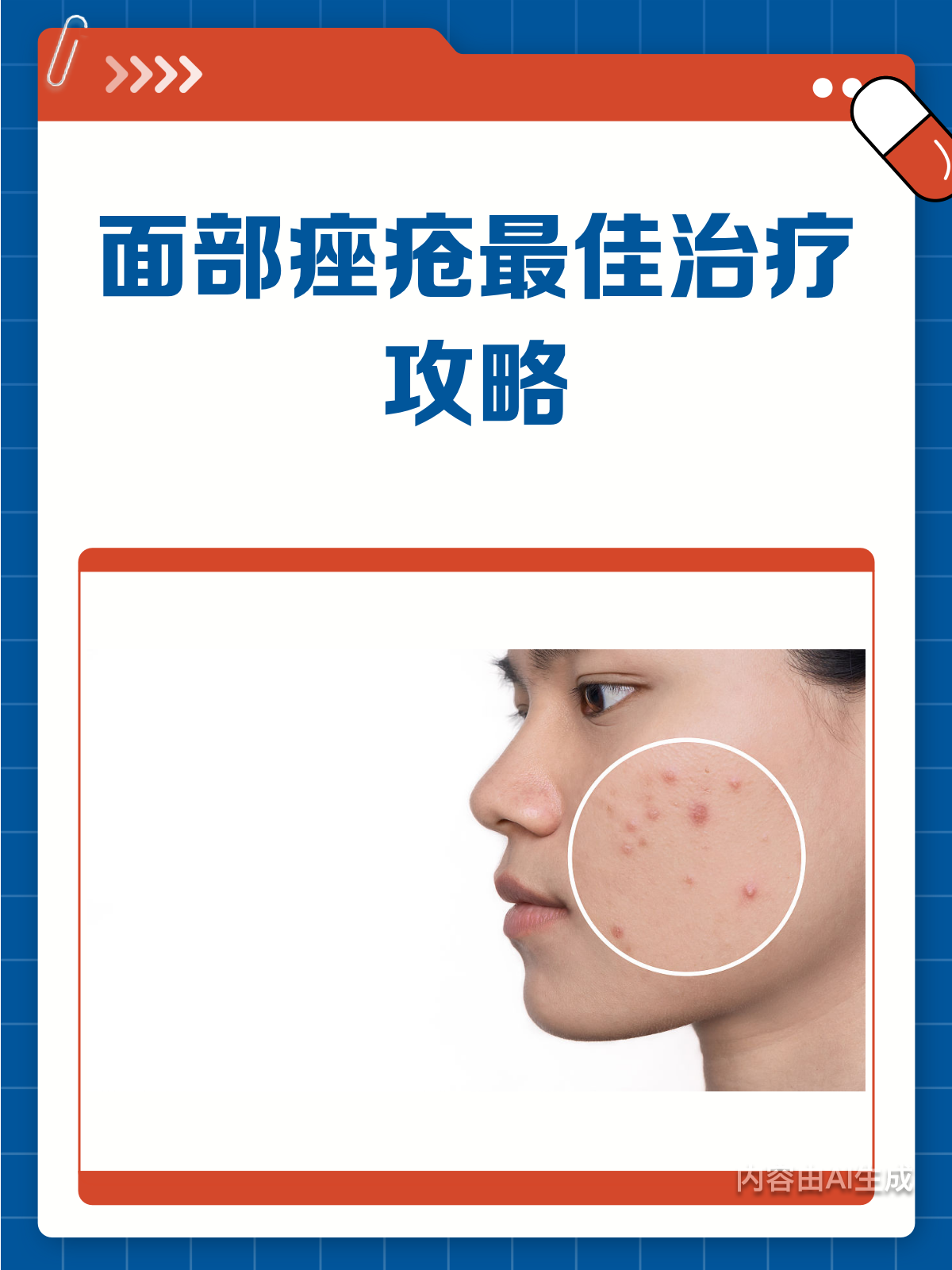 面部痤疮怎么办?这份治疗攻略请收好