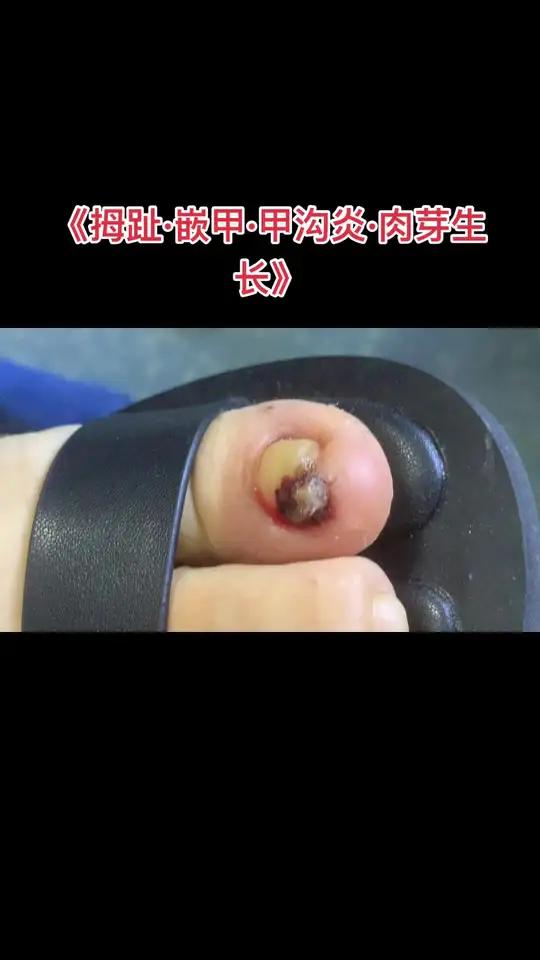 这种肉芽注意消毒 每天消毒 等待肉芽干燥 长期流血不愈合的可以考虑手术足足趾脚趾大脚趾大拇