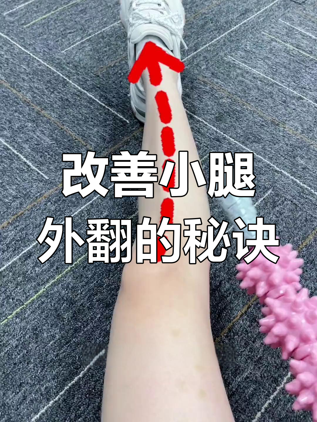 小腿外翻真的是骨头问题?不,其实是肌肉发力不对