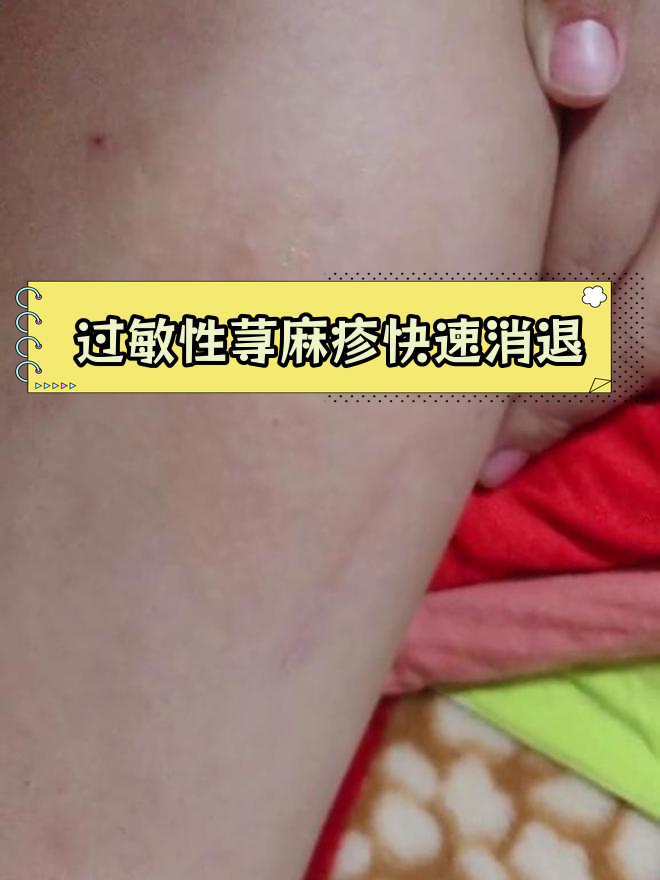 孩子吃虾引发过敏性荨麻疹,抹药后迅速缓解